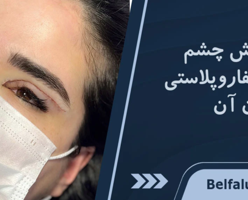آبریزش چشم بعد از عمل بلفاروپلاستی