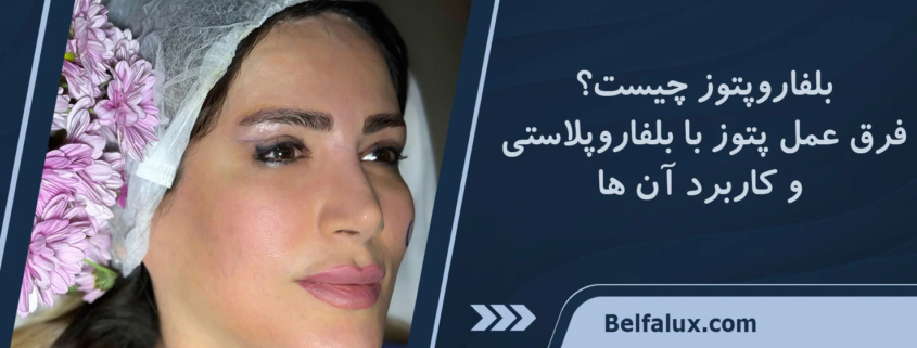 بلفاروپتوز چیست