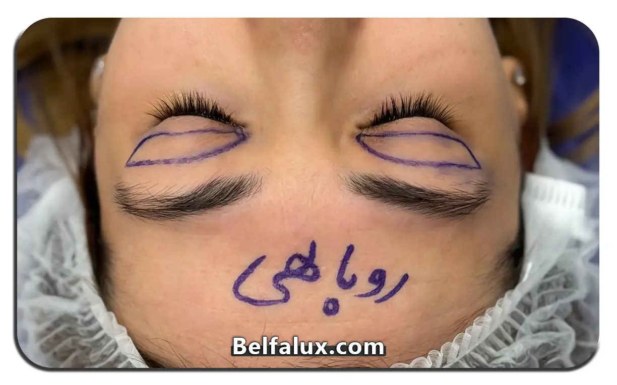 تاری دید بعد از عمل بلفاروپلاستی