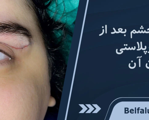 عفونت چشم بعد از عمل بلفاروپلاستی