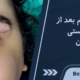 عفونت چشم بعد از عمل بلفاروپلاستی
