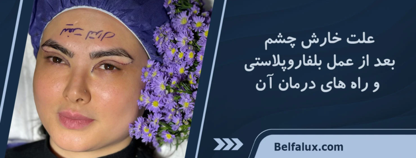 خارش چشم بعد از عمل بلفاروپلاستی