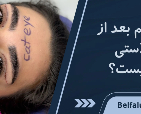 قرمزی داخل چشم بعد از عمل بلفاروپلاستی