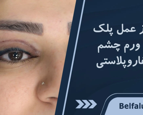 پف چشم بعد از عمل پلک