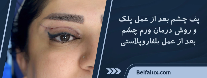 پف چشم بعد از عمل پلک