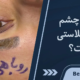 گودی چشم بعد از بلفاروپلاستی