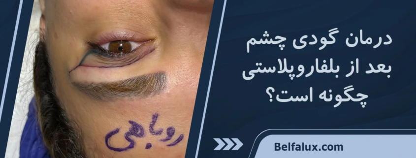 گودی چشم بعد از بلفاروپلاستی