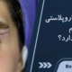 گوشت اضافه بعد از عمل پلک