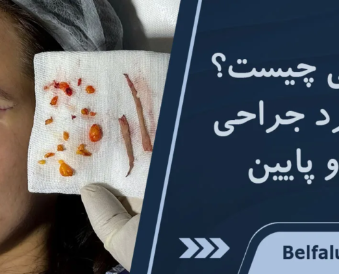 بلفاروپلاستی چیست