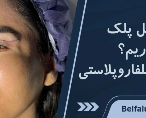 بعد از بلفاروپلاستی چی بخوریم