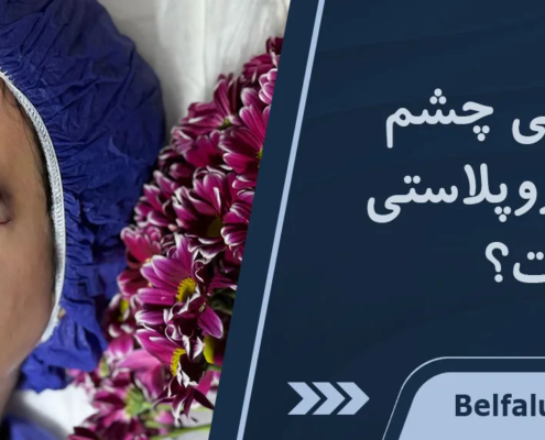 خشکی چشم بعد از بلفاروپلاستی