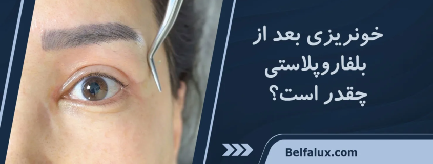 خونریزی بعد از بلفاروپلاستی