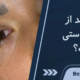 عمل بلفاروپلاستی درد دارد