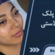 بی حسی پلک بعد از بلفاروپلاستی
