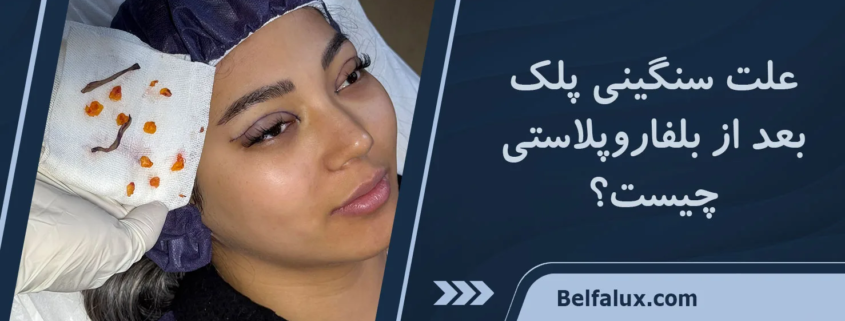 بی حسی پلک بعد از بلفاروپلاستی