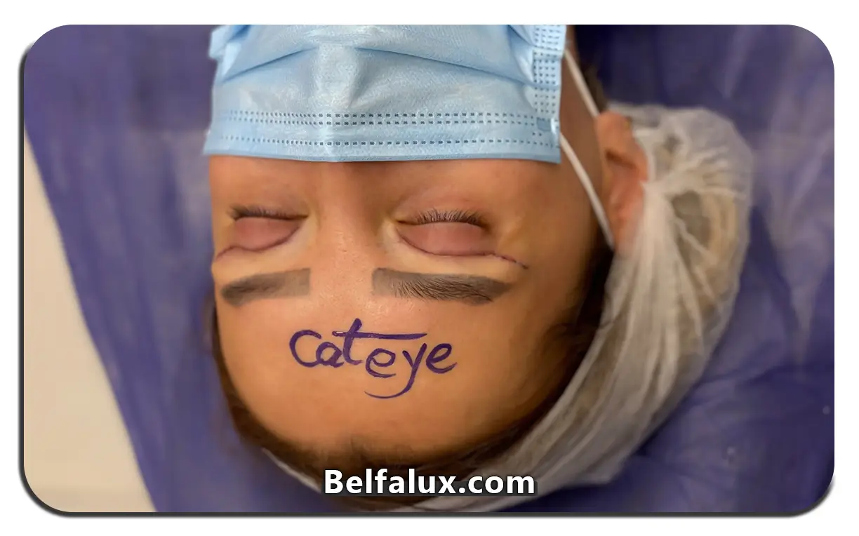 کانتوپلاستی چیست