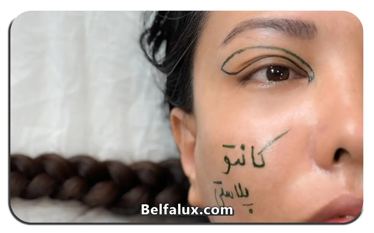 کانتوپلاستی چیه 