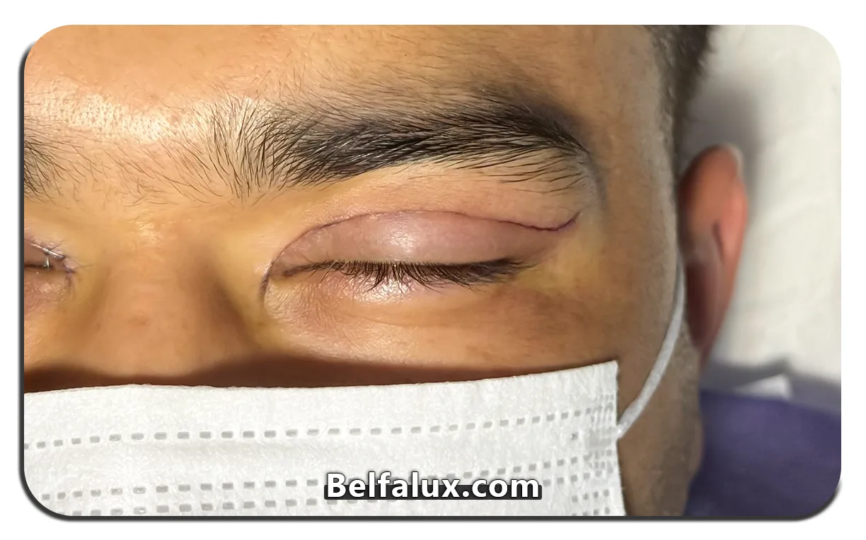 بلفاروپلاستی یا لیفت ابرو 