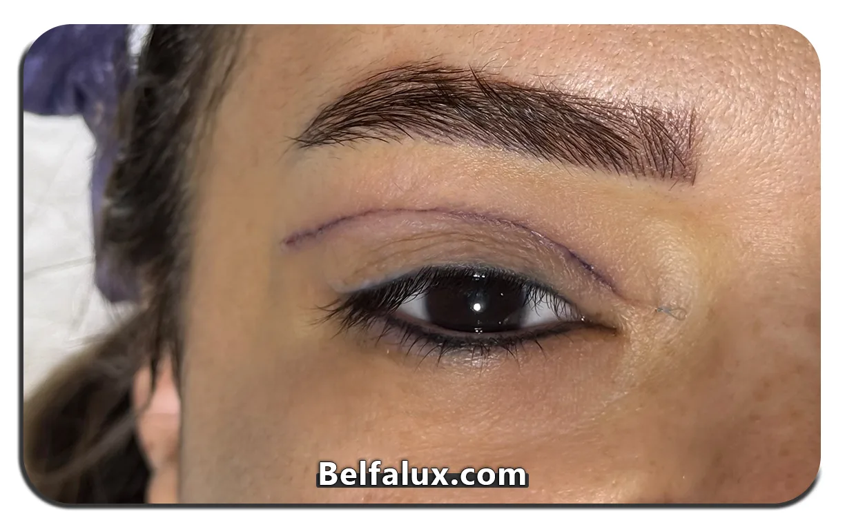 بلفاروپلاستی بهتر است یا لیفت ابرو 