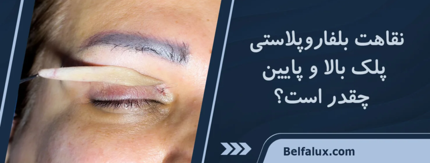 مراقبت بعد بلفاروپلاستی