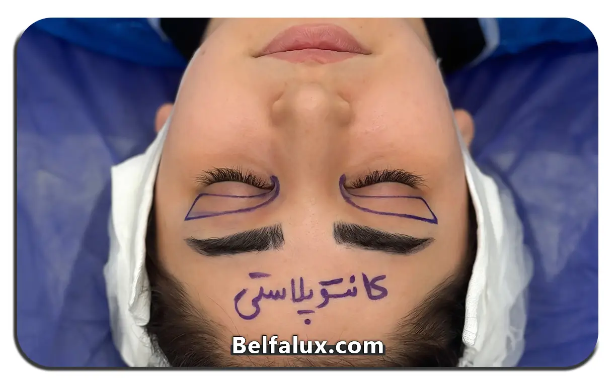 عمل چشم گربه ای چیست 