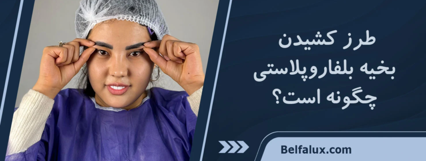 کشیدن بخیه بلفاروپلاستی