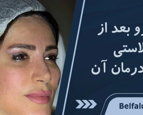 افتادگی ابرو بعد از بلفاروپلاستی