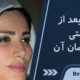 افتادگی ابرو بعد از بلفاروپلاستی